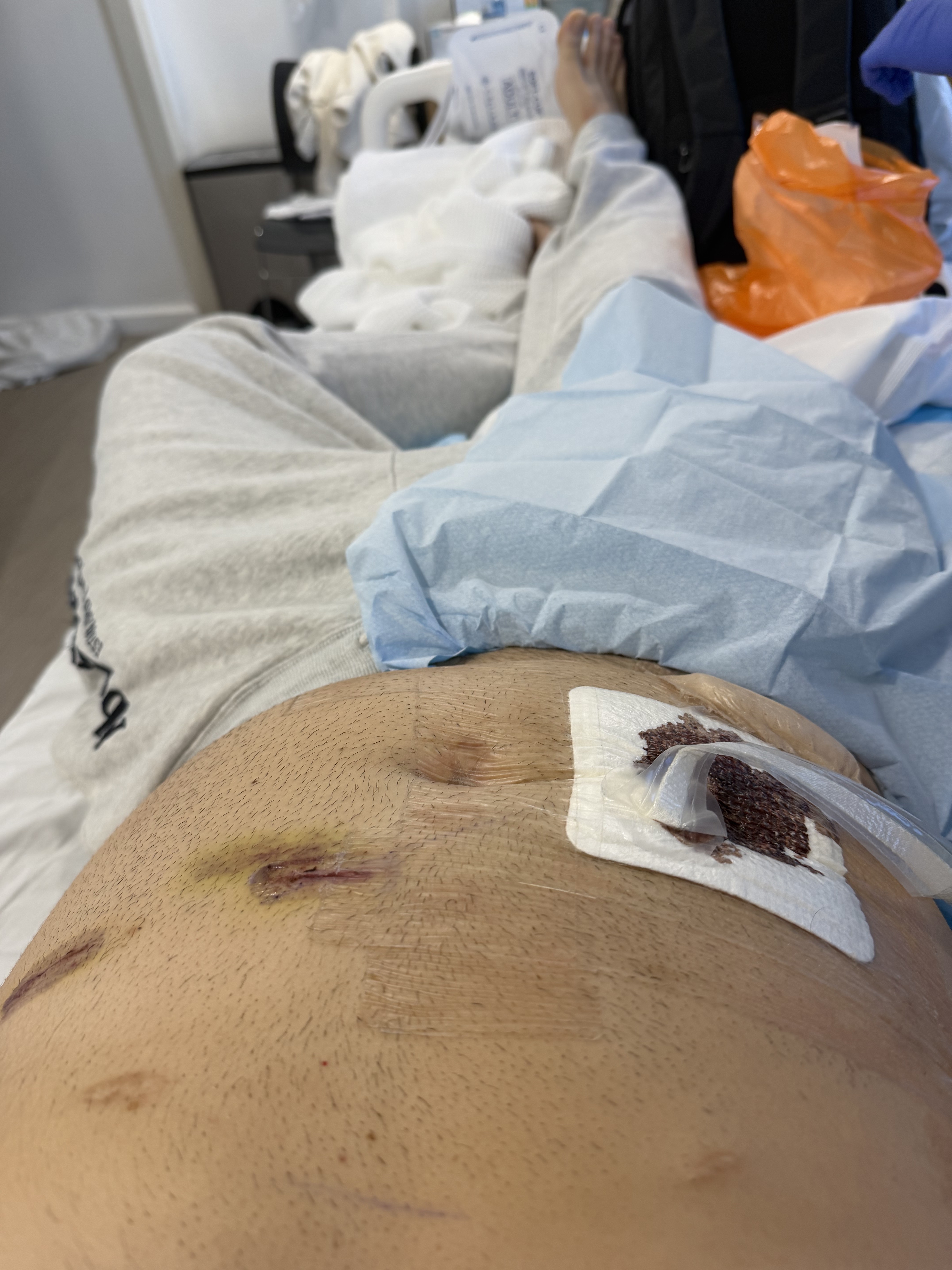 Surgical site following bowel reconstruction