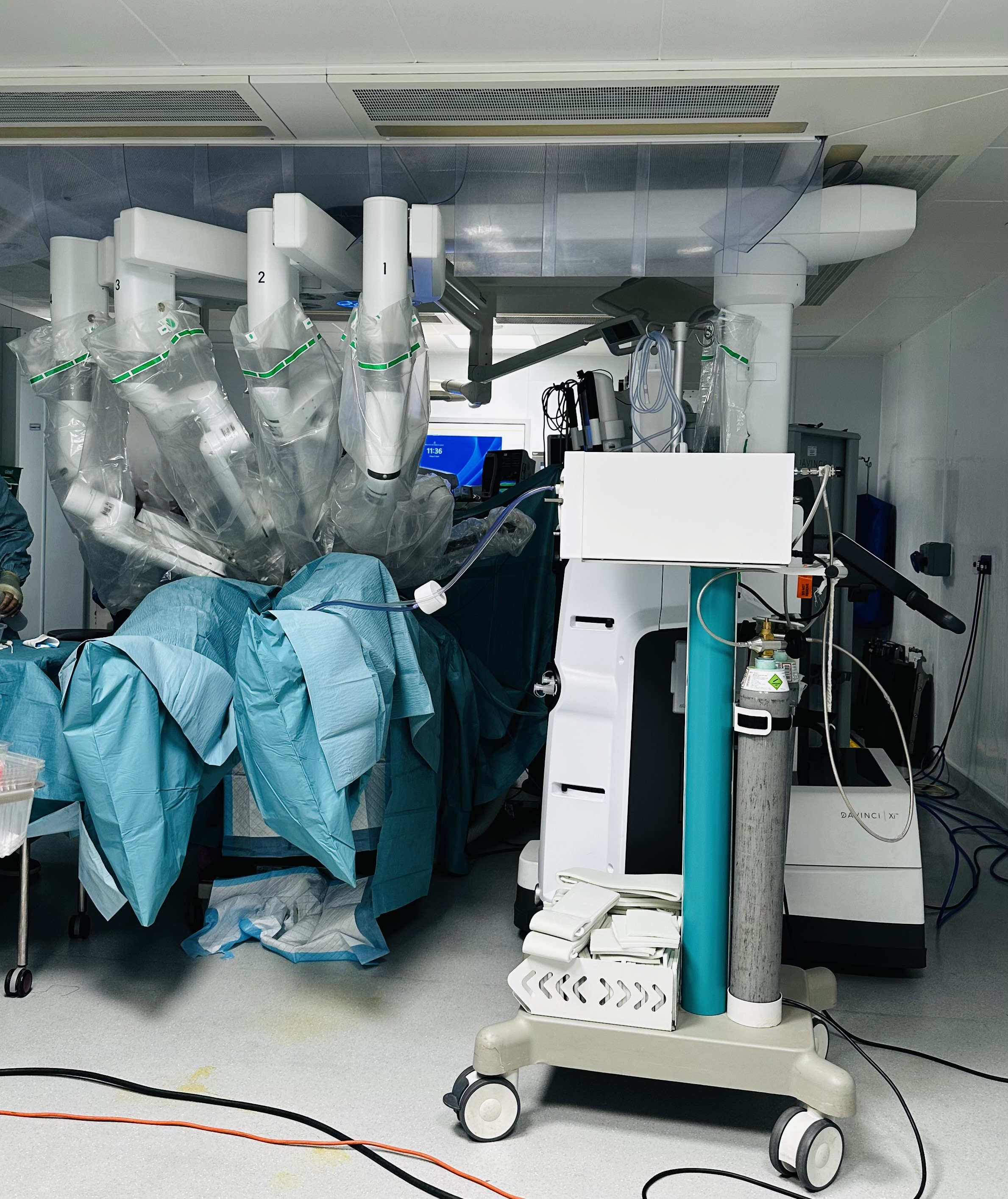 Michael in theatre with the Da Vinci Xi robotic surgery system during his reconstruction surgery